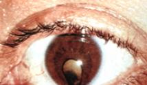 Шелушится кожа вокруг глаз – какими лекарствами лечить, причины